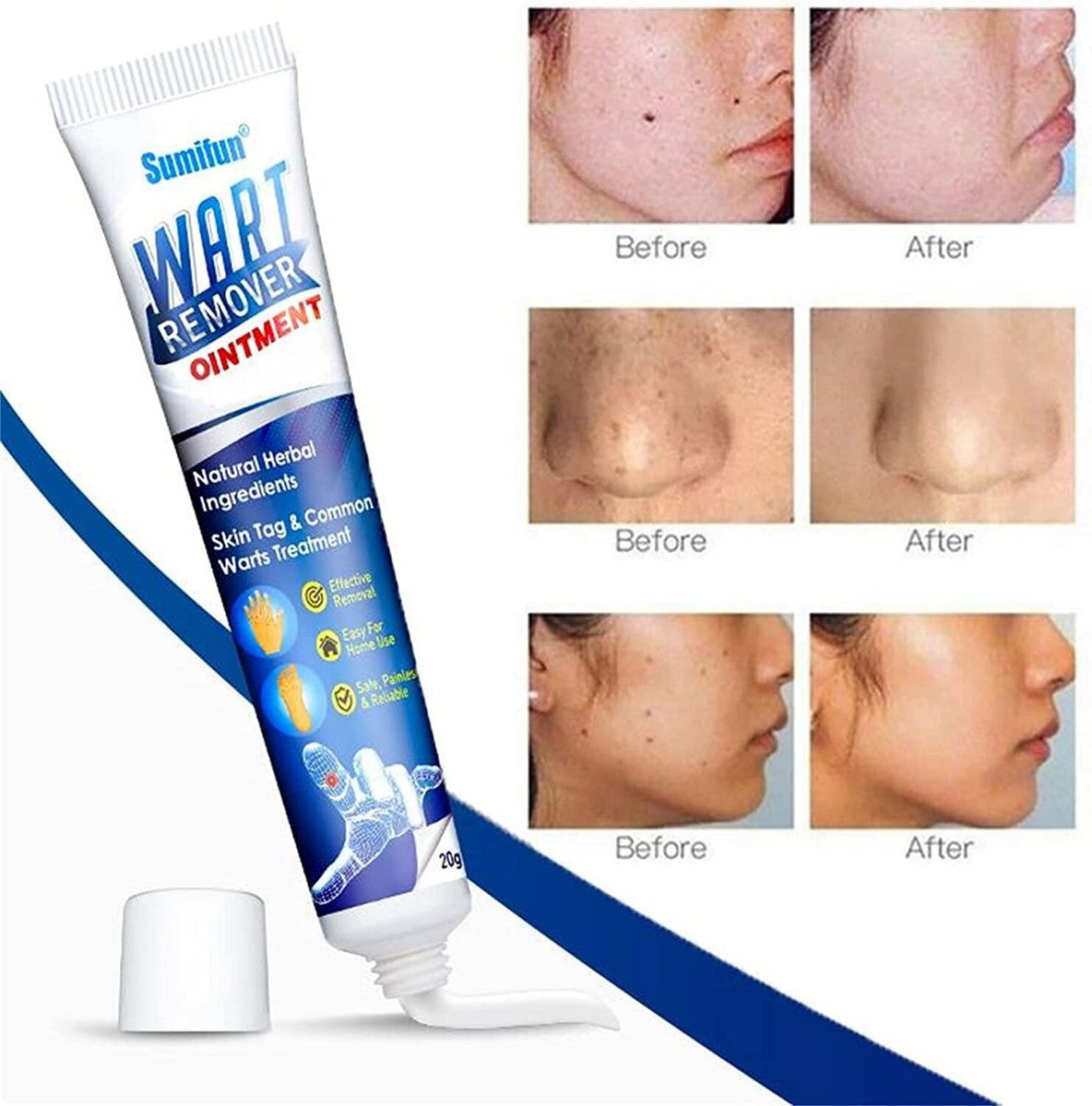 Wart Remover Cream (100 g, Pack of 3)